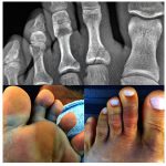 ケリー・スレーターが左足の人差し指と中指を骨折。どうなるワールドタイトル争い！？